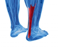 An Achilles Tendon Injury May Cause Severe Pain