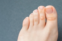 Definition and Common Causes of Corns on the Feet