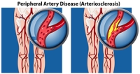 Definition and Risk Factors of Peripheral Artery Disease