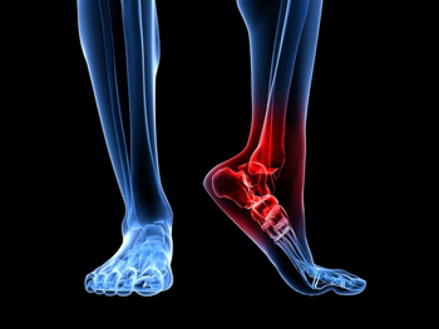 Home Remedies for Bone Spurs (Exostosis) - GoodRx