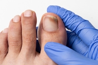 Causes and Preventive Measures for Toenail Fungus